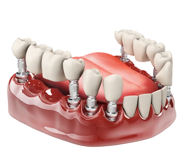 مرکز ایمپلنت دندان سهروردی