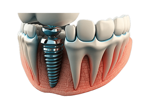 مرکز ایمپلنت دندان