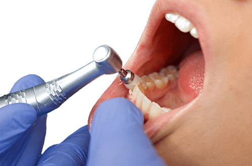 مرکز جرم‌گیری دندان