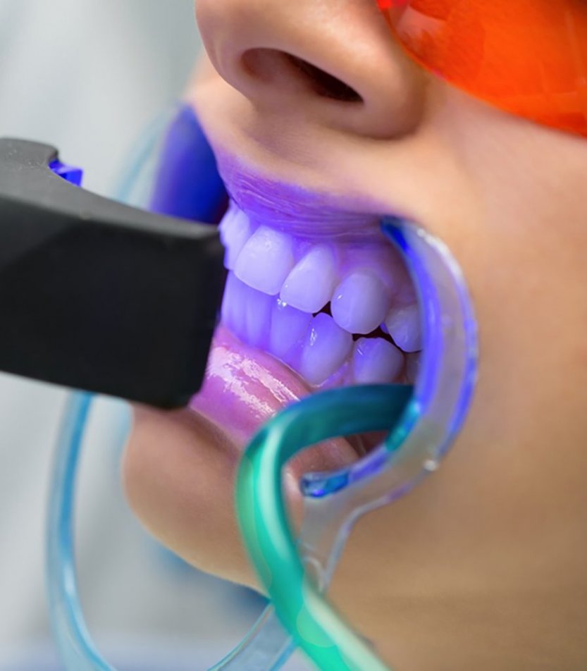 مرکز بلیچینگ دندان در سهروردی