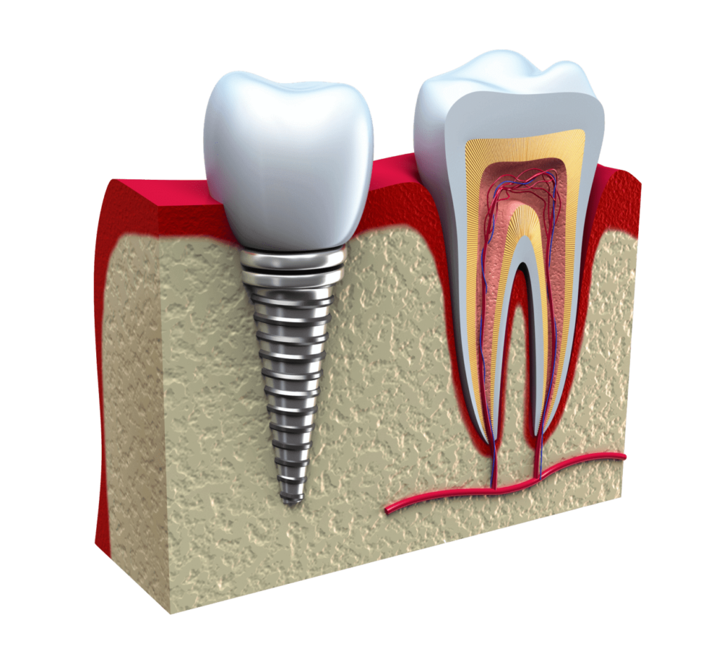 مرکز ایمپلنت دندان در سهروردی