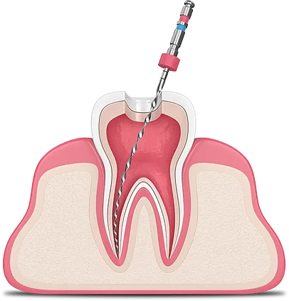 مرکز عصب کشی