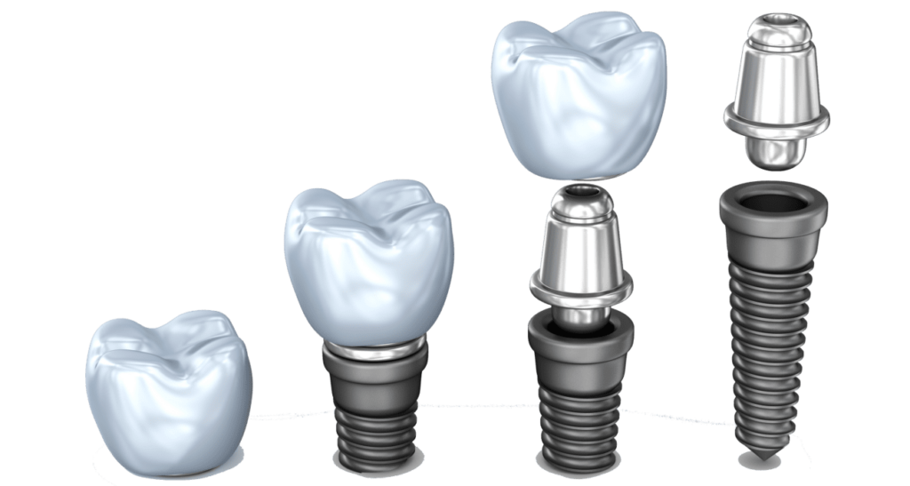 مرکز ایمپلنت دندان سهروردی