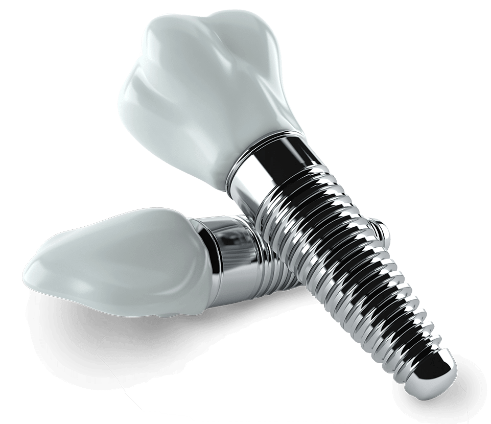 ایمپلنت دندان