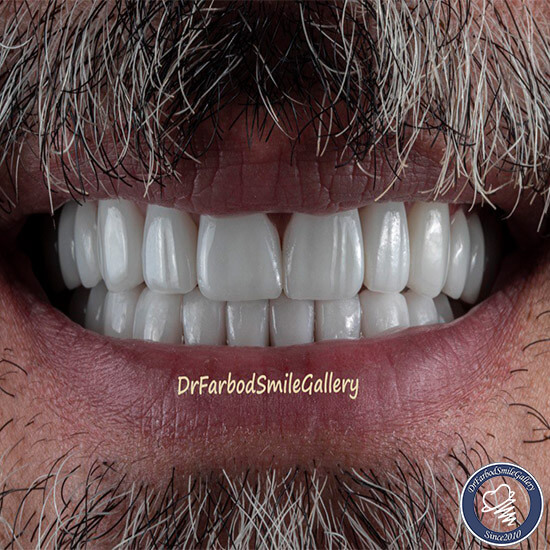 لمینت سرامیکی دندان