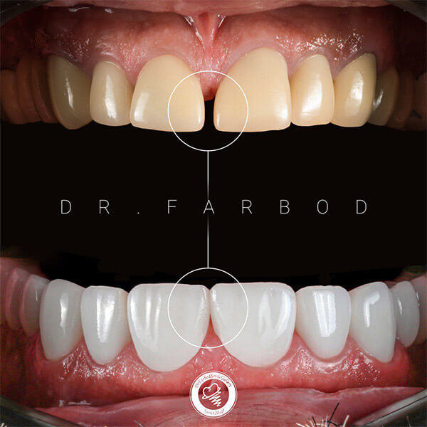 مرکز ونیر کامپوزیت دندان