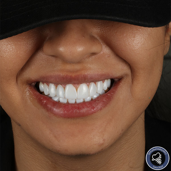 مرکز ونیر کامپوزیت دندان