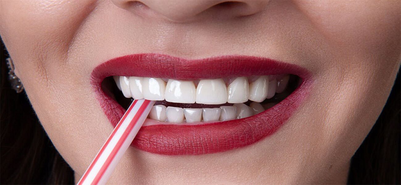 مرکز ونیر کامپوزیت دندان سهروردی