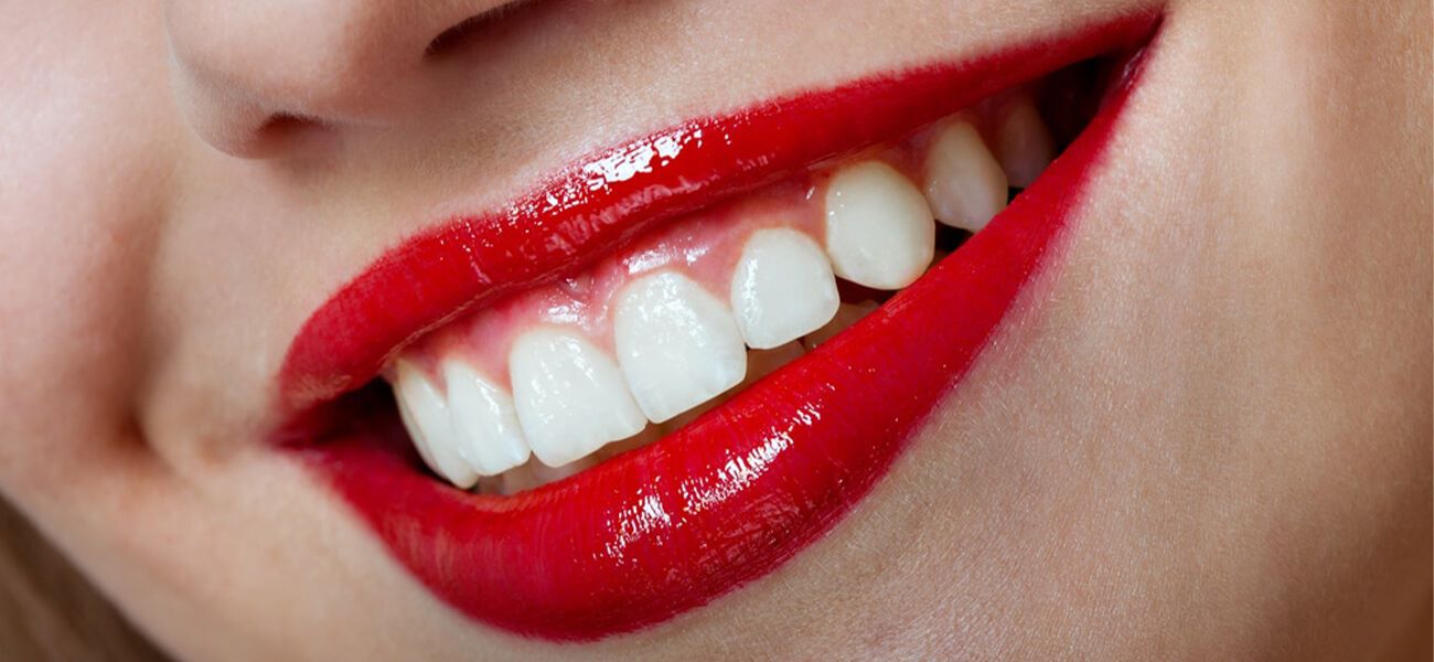 مرکز ونیر کامپوزیت دندان در سیدخندان