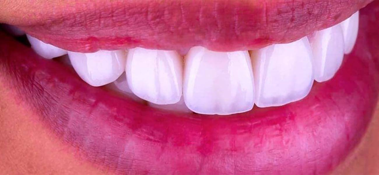 مرکز ونیر کامپوزیت دندان در سیدخندان