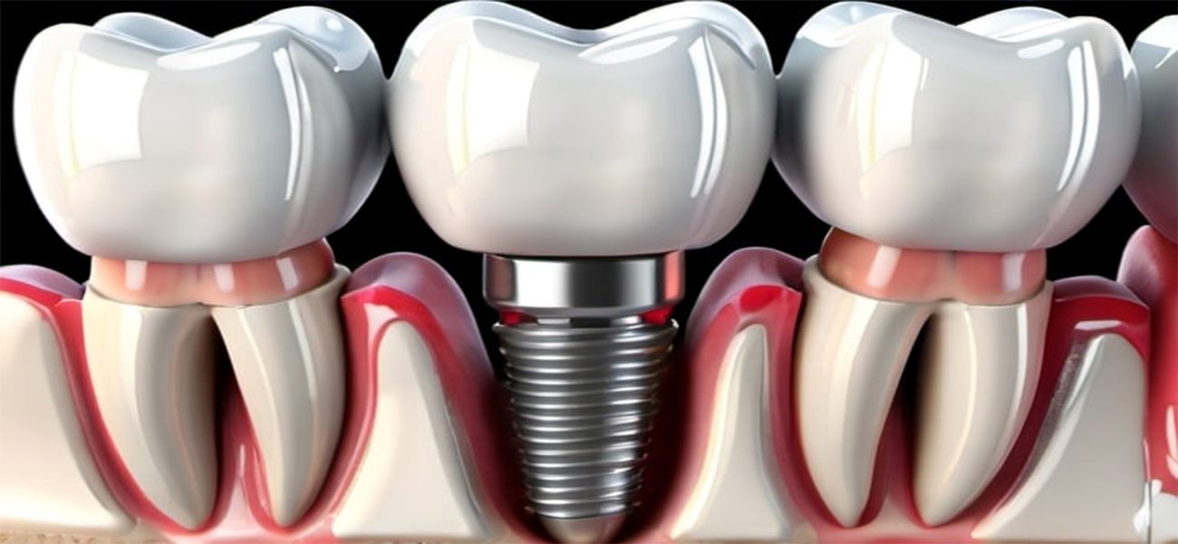 بهترین جراح ایمپلنت دندان